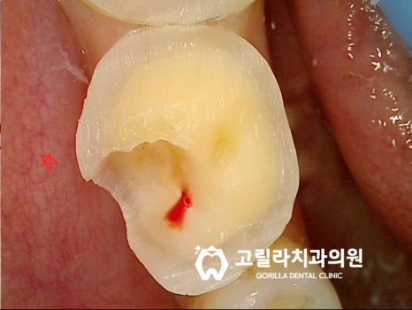 오래된 아말감의 교체 - 2차 충치 이미지 15