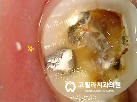 오래된 아말감의 교체 - 2차 충치 이미지 12