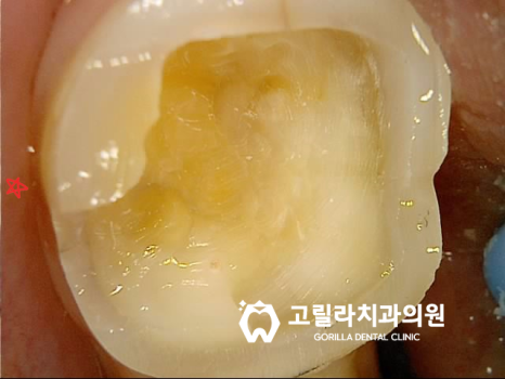 오래된 아말감의 교체 - 2차 충치 이미지 14