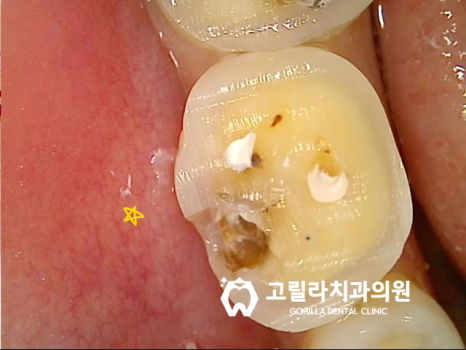 오래된 아말감의 교체 - 2차 충치 이미지 13