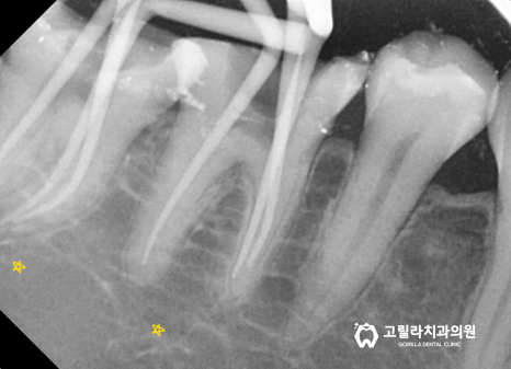 오래된 아말감의 교체 - 2차 충치 이미지 16