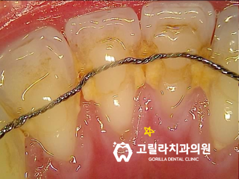 까맣게 변한 앞니 치료 이미지 7
