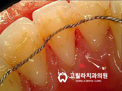 까맣게 변한 앞니 치료 이미지 8