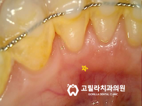 심한 충치, 신경치료를 통한 자연치아 살리기 + 턱관절 보톡스 이미지 5