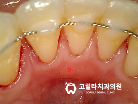 심한 충치, 신경치료를 통한 자연치아 살리기 + 턱관절 보톡스 이미지 6