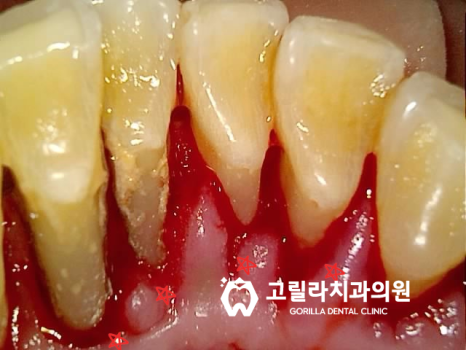치주염으로 인한 앞니 브릿지 치료 이미지 7
