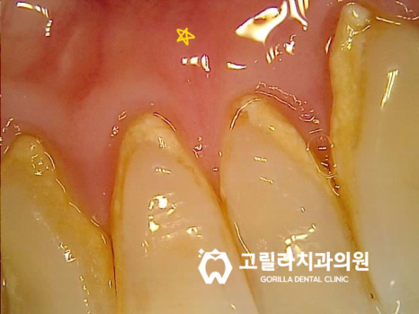 충치치료(인레이,크라운,임플란트) 이미지 6