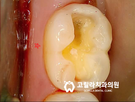 자연치아 보존치료, 인레이 크라운 치료 (치실 사용 중요성) 이미지 15