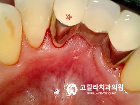 앞니 심미 보철 (크라운, 브릿지) 이미지 8