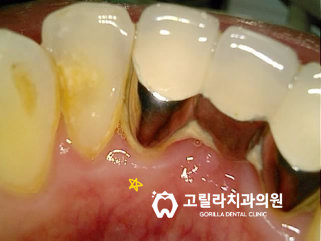 앞니 심미 보철 (크라운, 브릿지) 이미지 7