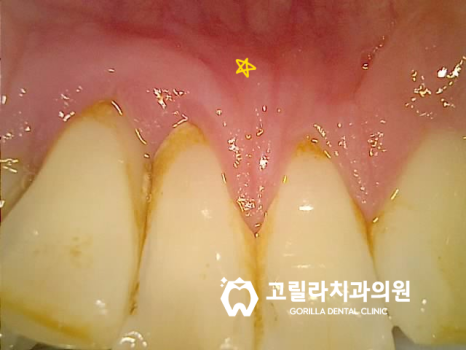 씹을 때 찌릿한 치아,당일 임플란트 수술 이미지 13
