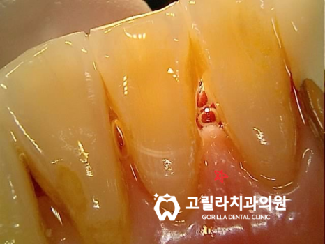 오래된 앞니 보철물이 깨지는 이유 이미지 9