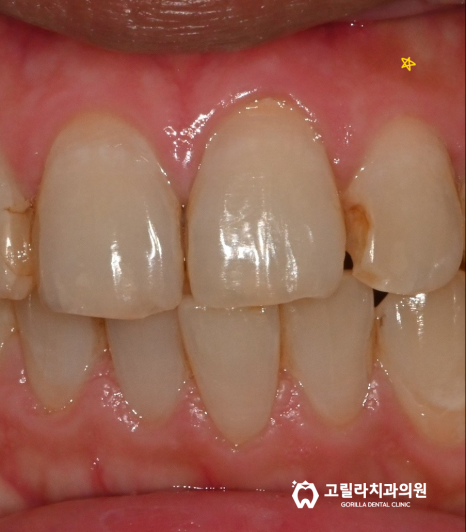자연치아 살리기, 오래된 보철물의 치료 이미지 15