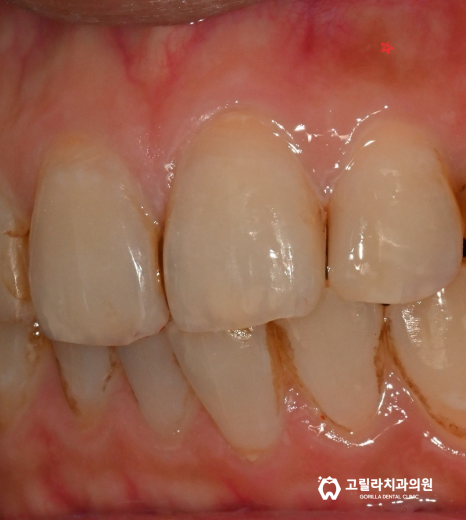 자연치아 살리기, 오래된 보철물의 치료 이미지 16