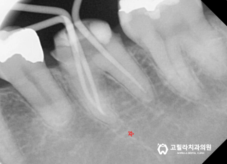 자연치아 살리기, 오래된 보철물의 치료 이미지 17
