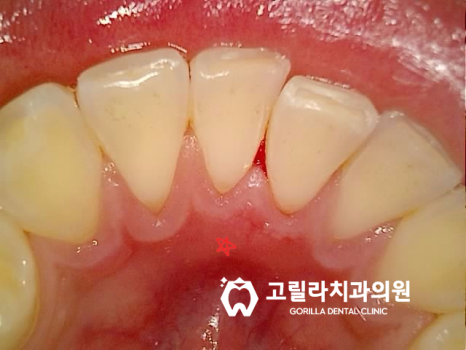 앞니 레진이 떨어졌어요 , 잇몸성형 & 올세라믹 크라운 이미지 7