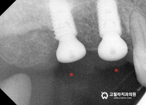 상악동 거상술을 동반한 임플란트 수술 이미지 18