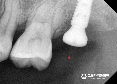 상악동 거상술을 동반한 임플란트 수술 이미지 19