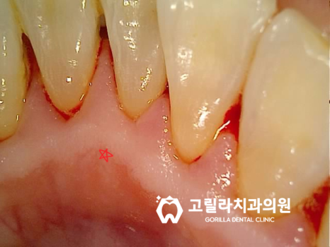 상악동 거상술을 동반한 임플란트 수술 이미지 12