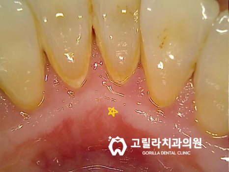 상악동 거상술을 동반한 임플란트 수술 이미지 11