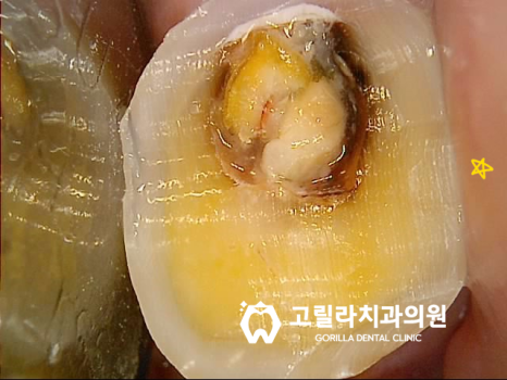 상악동 거상술을 동반한 임플란트 수술 이미지 16