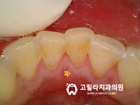 자연치아 살리기 *신경치료* 이미지 7