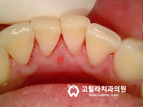 자연치아 살리기 *신경치료* 이미지 8
