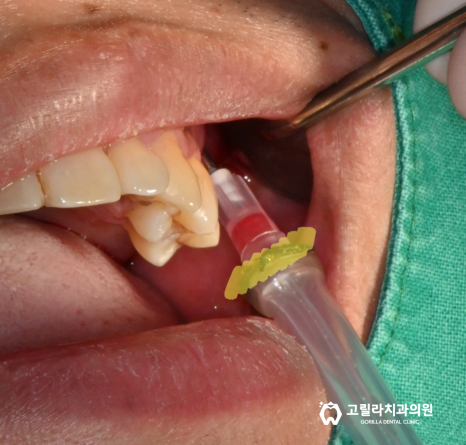 고난이도 임플란트 수술 * 상악동 세척술 & 상악동 거상술 * 이미지 14
