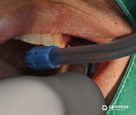고난이도 임플란트 수술 * 상악동 세척술 & 상악동 거상술 * 이미지 13
