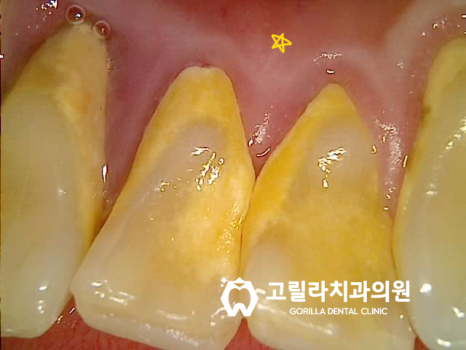 고난이도 임플란트 수술 * 상악동 세척술 & 상악동 거상술 * 이미지 10