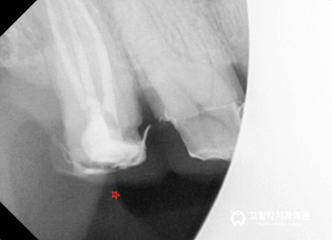 자연치아 살리기 *뿌리 끝 염증 신경치료 * 이미지 10