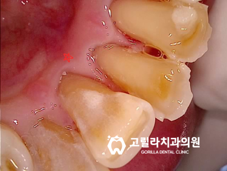 자연치아 살리기 *뿌리 끝 염증 신경치료 * 이미지 8