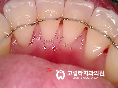 상악동 세척술 & 임플란트 수술 이미지 11