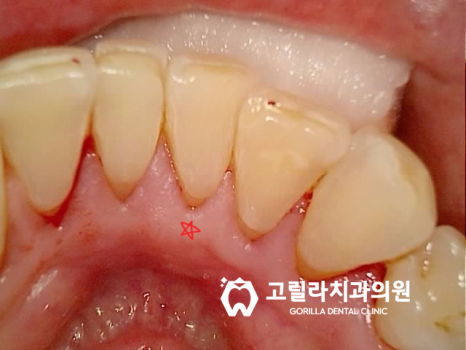 타치과 임플란트 재수술 & 상악동 거상술 이미지 10