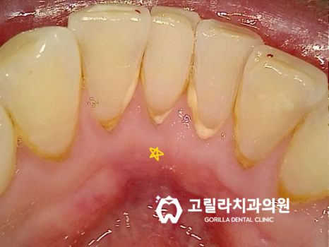타치과 임플란트 재수술 & 상악동 거상술 이미지 9