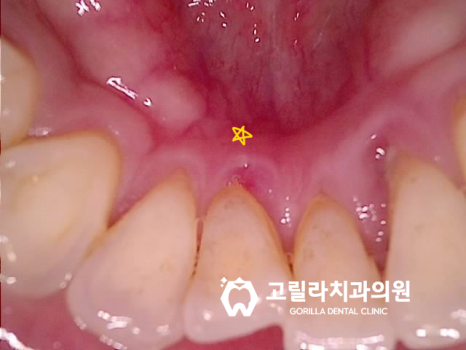 치주염으로 인한 고난이도 임플란트 수술 이미지 9