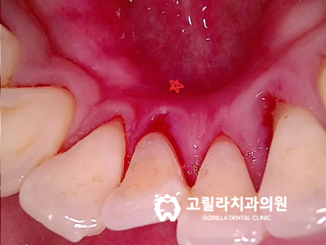 치주염으로 인한 고난이도 임플란트 수술 이미지 10