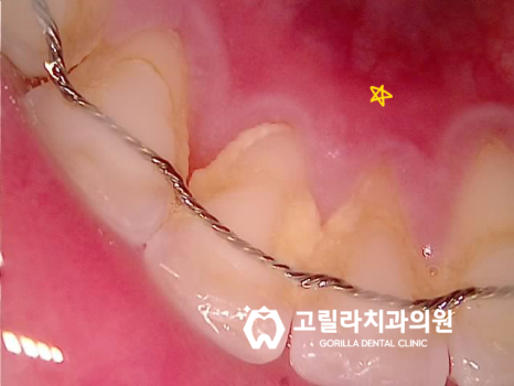 영구치 결손으로 인해 잔존 유치 -> 임플란트 이미지 6