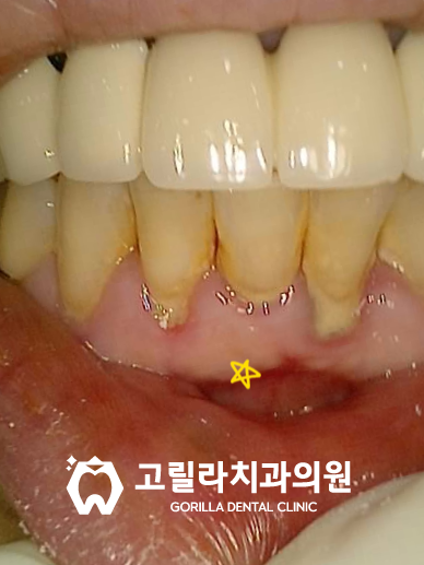 사랑니로 인한 치주염 발치 & 임플란트 이미지 6