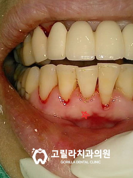 사랑니로 인한 치주염 발치 & 임플란트 이미지 7