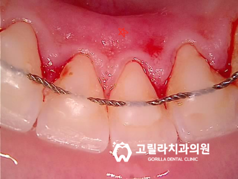 치실중요성 - 신경치료 , 크라운 보철치료 이미지 8