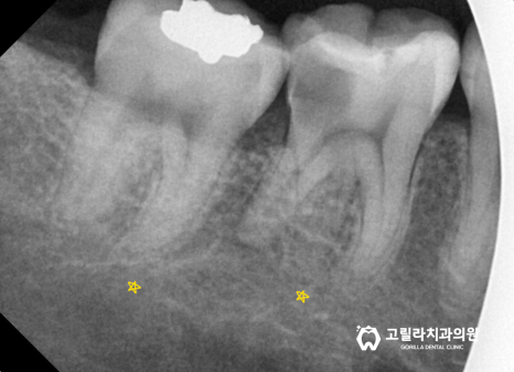 치실중요성 - 신경치료 , 크라운 보철치료 이미지 9