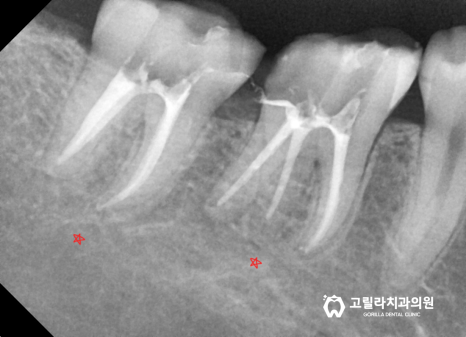 치실중요성 - 신경치료 , 크라운 보철치료 이미지 12