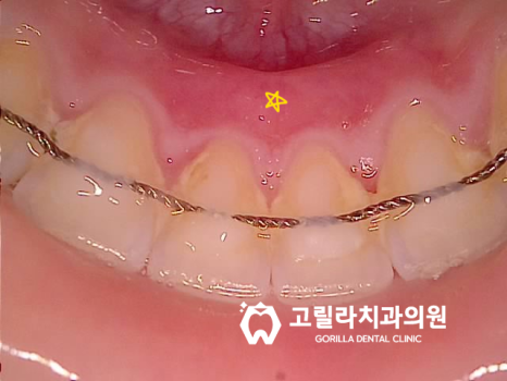 치실중요성 - 신경치료 , 크라운 보철치료 이미지 7