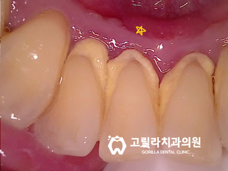 자연치아 살리기 - 신경치료 이미지 7