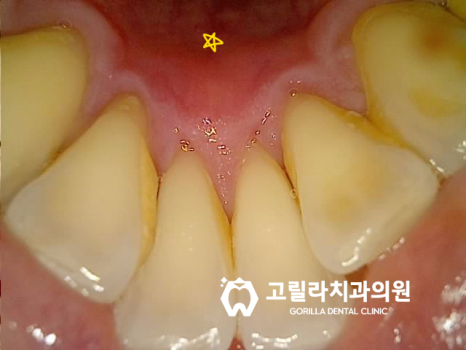 [강한 교합력]으로 인한 크랙치아 임플란트 이미지 8