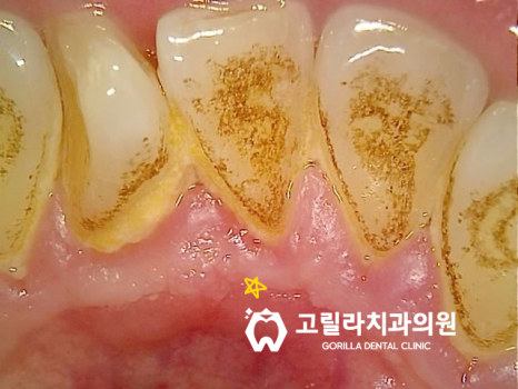 고난이도 사랑니매복발치