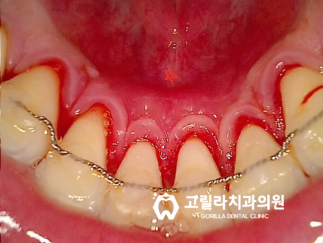 [임플란트] 상악동거상술, 남은 뼈에 맞춘 방법 선택 이미지 9