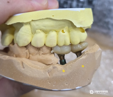 임플란트 보철의 중요성 이미지 2