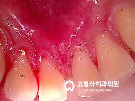 [최소삭제 라미네이트] 깨진 치아, 누런치아 이미지 6